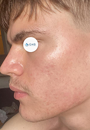 An image of the Client after undergoing GHB CLinic London Treatment