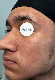 An image of the Client after undergoing Acne Laser Treatment