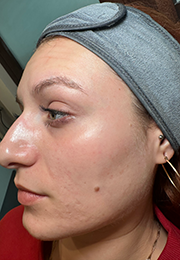 An image of the Client after undergoing Acne Laser Treatment