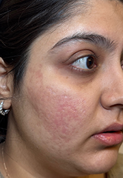 An image of the Client after undergoing GHB CLinic London Treatment