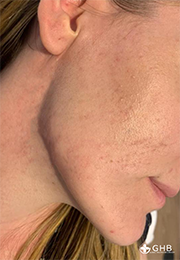 An image of the Client after undergoing Acne Laser Treatment