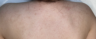 An image of the Client after undergoing Acne Laser Treatment