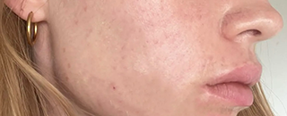 An image of the Client after undergoing Acne Laser Treatment