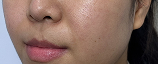 An image of the Client after undergoing Acne Laser Treatment