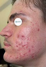 An image of the Client before undergoing GHB CLinic London Treatment
