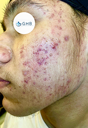 An image of the Client before undergoing Acne Laser Treatment