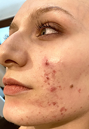 An image of the Client before undergoing Acne Laser Treatment