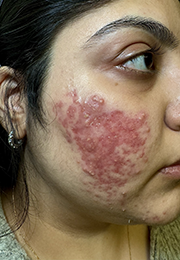 An image of the Client before undergoing GHB CLinic London Treatment