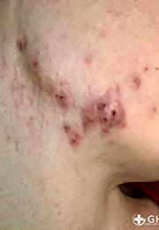 An image of the Client before undergoing Acne Laser Treatment