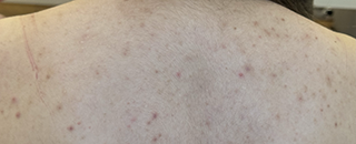 An image of the Client before undergoing Acne Laser Treatment