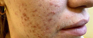 An image of the Client before undergoing Acne Laser Treatment