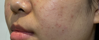 An image of the Client before undergoing Acne Laser Treatment