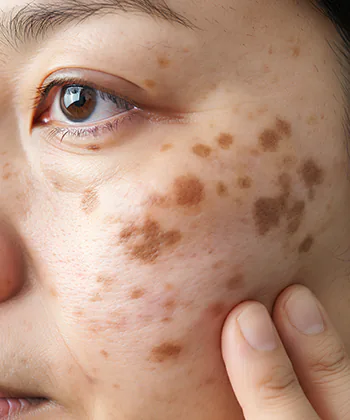 Transformation example of Facial Acne Condition to Glowing Skin