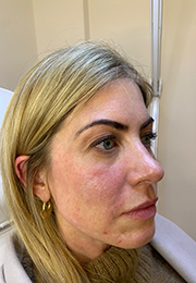 An image of the Client after undergoing GHB CLinic London Treatment