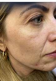 An image of the Client before undergoing GHB CLinic London Treatment