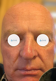 An image of the Client after undergoing Laser Skin Resurfacing Treatment