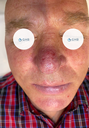 An image of the Client before undergoing Laser Skin Resurfacing Treatment