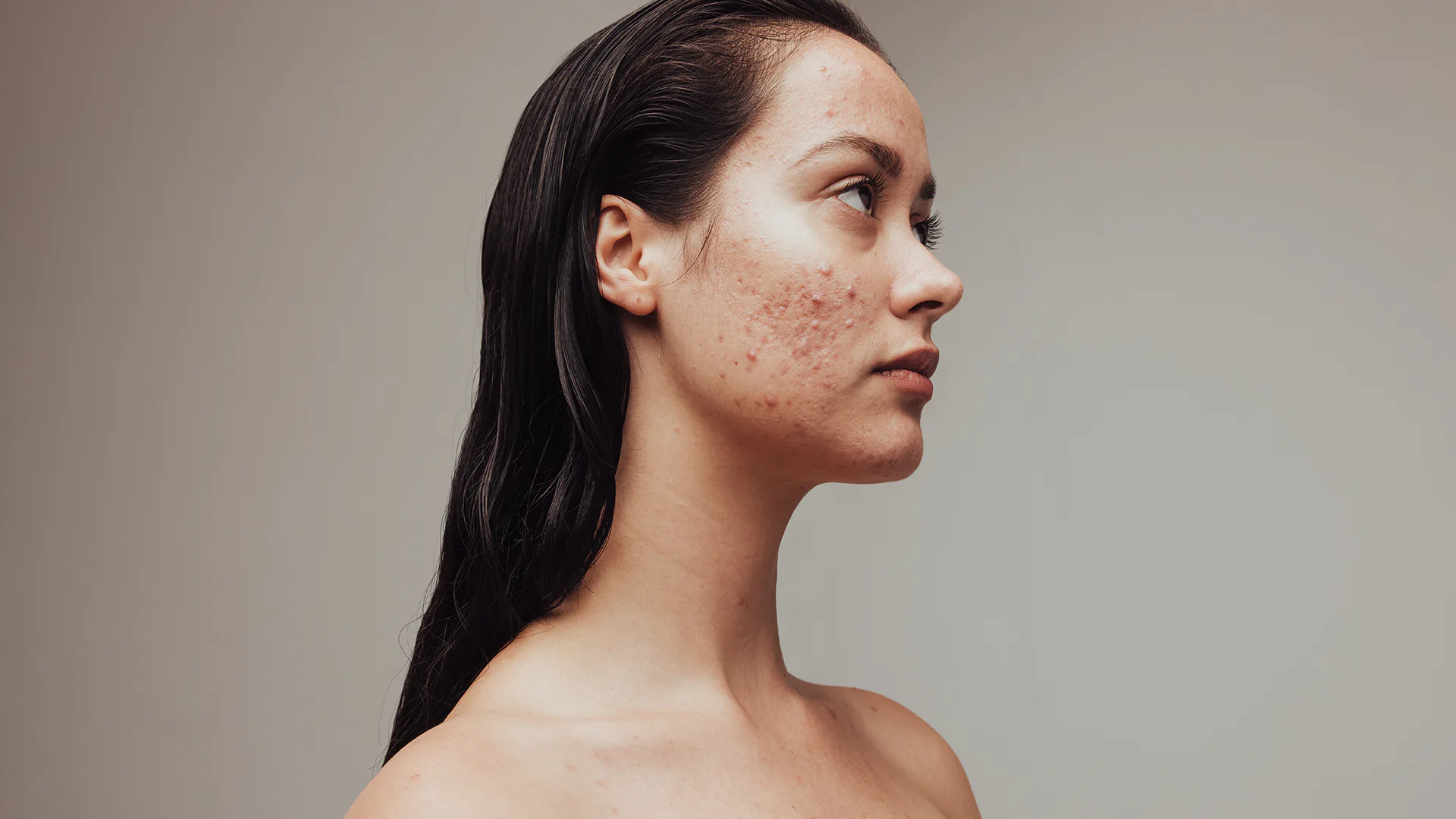 Resizable background image representing Acne Laser Treatment