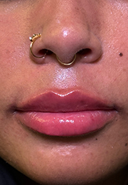 An image of the Client after undergoing GHB CLinic London Treatment