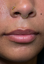 An image of the Client before undergoing GHB CLinic London Treatment
