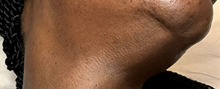 An image of the Client after undergoing Mole Removal