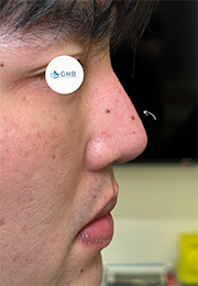 An image of the Client after undergoing Nose Filler