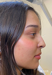 An image of the Client after undergoing Nose Filler