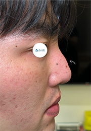 An image of the Client before undergoing Nose Filler