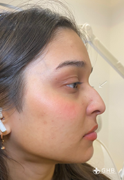 An image of the Client before undergoing Nose Filler