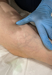 An image of the Client after undergoing Spider Vein Laser Treatment