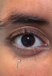 An image of the Client after undergoing GHB CLinic London Treatment