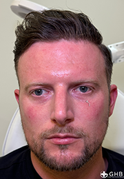 An image of the Client after undergoing GHB CLinic London Treatment