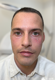 An image of the Client after undergoing GHB CLinic London Treatment