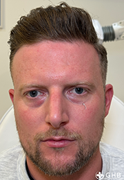 An image of the Client before undergoing GHB CLinic London Treatment