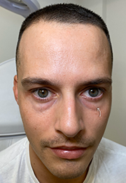 An image of the Client before undergoing GHB CLinic London Treatment